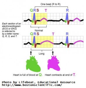 LQTS heart beat wave patterns